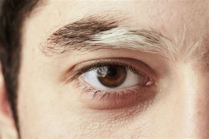 Does vitiligo go away?