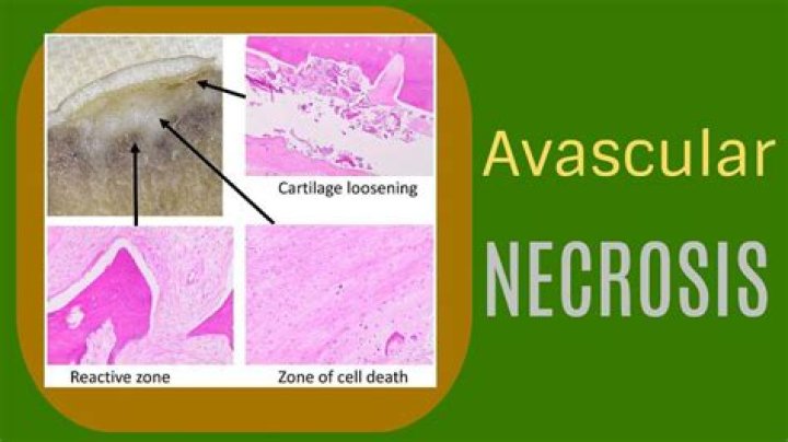 How serious is avascular necrosis?