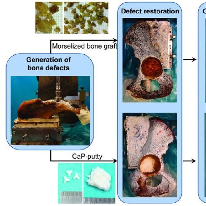 What is Morselized bone graft?